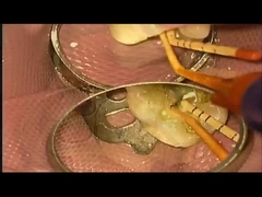 SANI ТРАТМЕНТ СУДОЖЕНИЕ